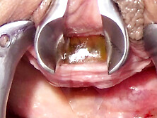 Peehole with German Probe Toothbrush and Chain into Urethra