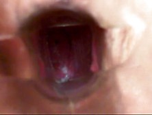 gynecological speculum in soaked crack.