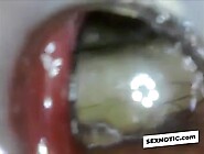 Anal Endoscope Ass Play From Inside