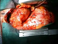 Woman Open Thymectomy