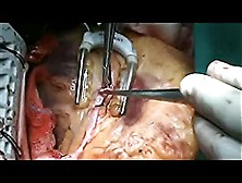 Retreival Impacted Stent Left Main Coronary Artery Cm. Flv