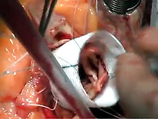 Aortic Valve Reconstruction Elderly Man Cm. Flv