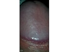 Web Find Foreskin Pulled Back Showing Papules