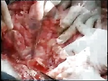 Open Thoracoabdominal Aortic Aneurysm Repair