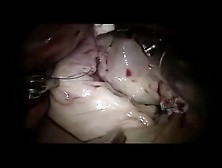 Robot-assisted mitral valve repair woman