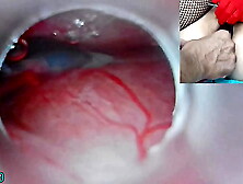 Asian Insemination with Spunk into Uterus and Endoscope Web-cam by Cervix to watch inside womb Uncensored