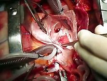 Artial Septal Defect Closure Woman 2 Cm. Flv