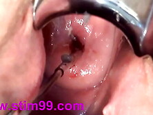 Cervix Fucking Play Deep Oriental Oriental - å­å®®é ¸éƒ¨ã‚¯ã‚½