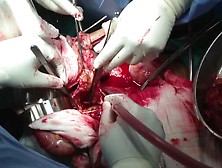 Open Abdominal Aortic Aneurysm Repair 4 Cm. Flv