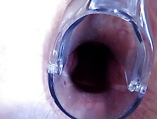 Stretching the anal and snatch with a gynecological speculum.  MILF with a large ass and a gaping ass-hole and a gaping snatch.