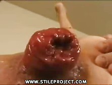 Big Anal Prolapse