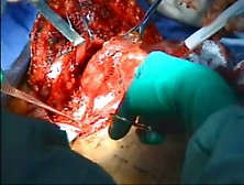 Hemiclamshell Thymectomy