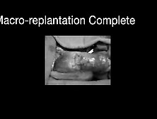 Penile Replantation Surgical Technique&management