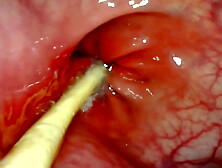 EXTREME ANAL SELF PERSPECTIVE.  ONLINE CAM INSIDE HER BUTT-HOLE AS I POUND HER WITH MY MONSTROUS PRICK AND SPUNK DEEP INSIDE