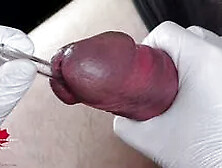 Perfect Extraction Of Sperm Directly From The Urethra.  Close-up Of The Glass Straw Sounding