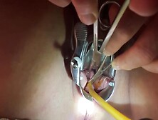 Tenaculum Grasping Cervix For Catheter 7 Min