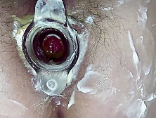 Hot Anal gaping & tunnel plug.  Hairy cunt & asshole close-up